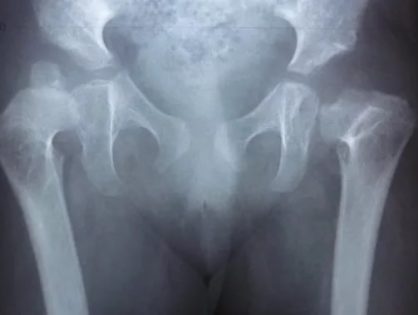 Вывих тазобедренного сустава у детей клиника thumbnail