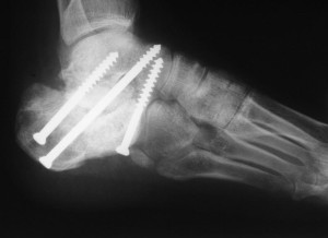 Переломы пяточной кости лечение скелетным вытяжением