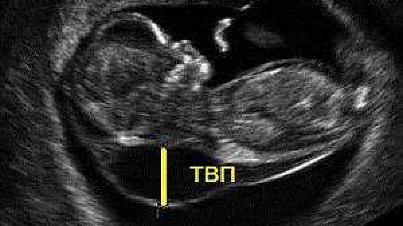 12 недель беременности что есть. 12 Недель беременности УЗИ ТВП. ТВП 12 недель синдром Дауна. ТВП 7.5. Скрининг беременности толщина воротникового пространства.
