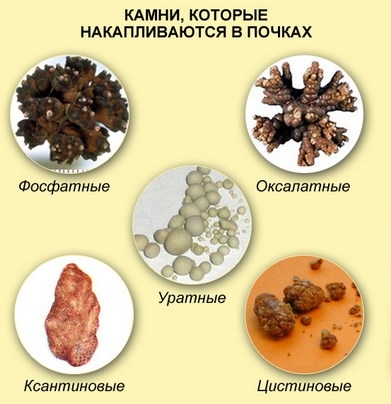 Схема мочеполовой системы у мужчин где появляются камни в почках