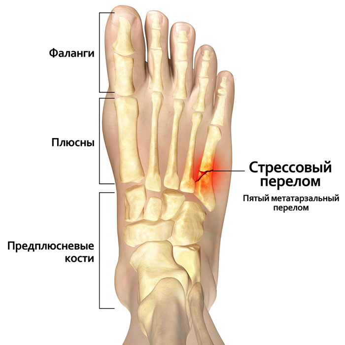 Массаж ноги после перелома плюсневой кости