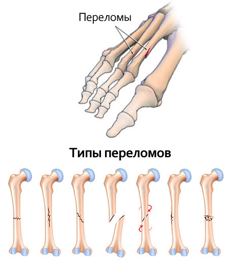 Снятие гипса после перелома ноги