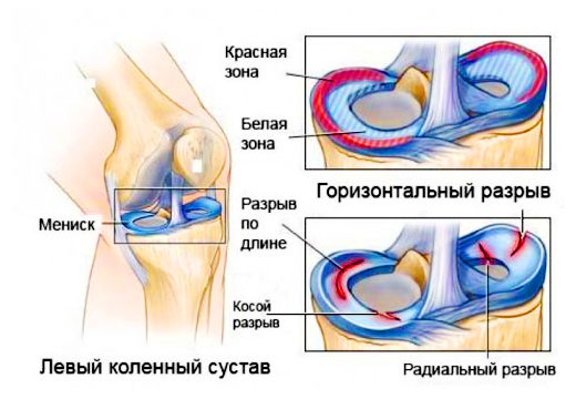 Реабилитация коленного сустава после ушиба