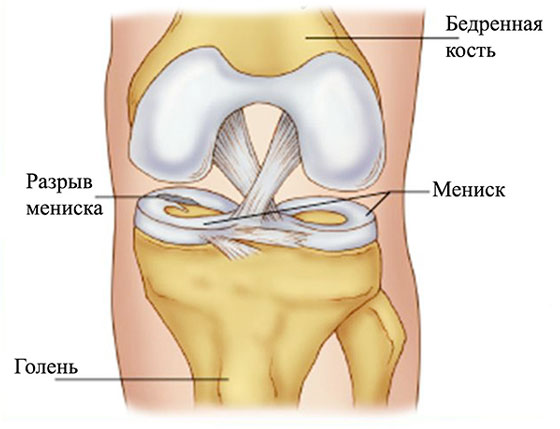 Комплекс упражнений при вывихе коленного сустава thumbnail