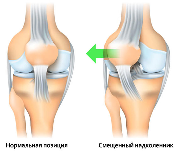 Упражнения на коленный сустав после вывиха