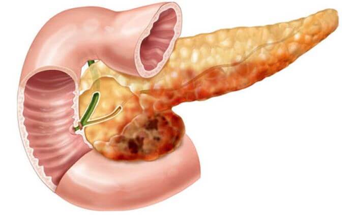 Что означает диффузные изменения поджелудочной железы по типу липоматоза thumbnail