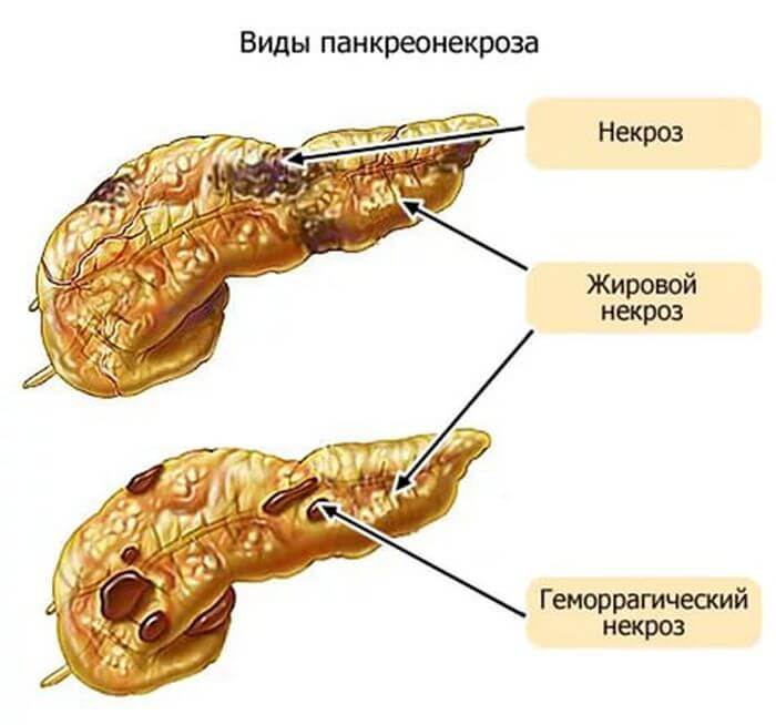 Vidy-pankreonekroza