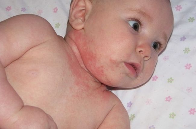Симптомы аллергии у младенца