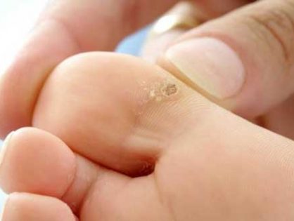 Как вылечить сухие мозоли на пальцах ног и подошве стопы в домашних условиях?