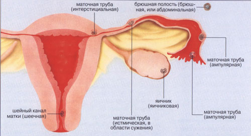 Понос признак внематочной беременности thumbnail