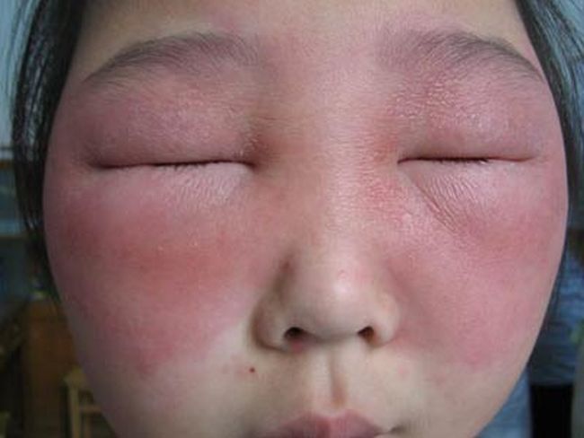 Опухшее лицо при аллергии