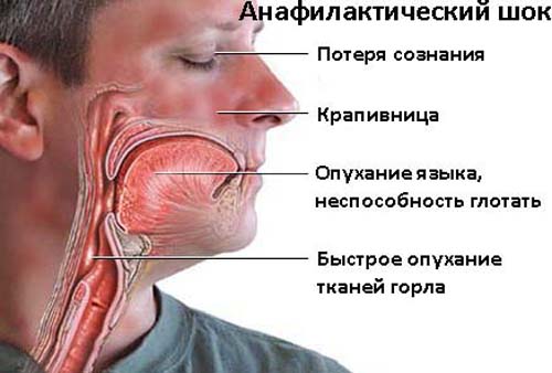 Пищевая аллергия отекло лицо thumbnail