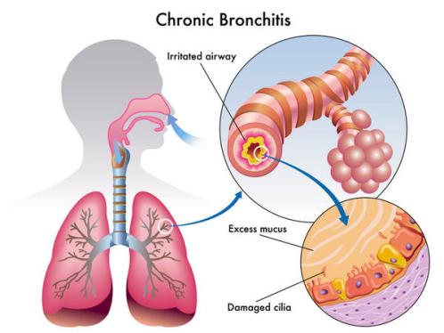 Симптомы бронхита у взрослых без кашля