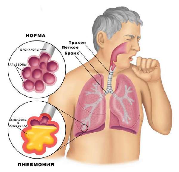 Можно ли заразиться пневмонией легких