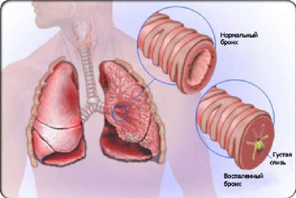 Пневмония и бронхит без симптомов