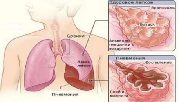 Пневмония или бронхит отличия на рентгене