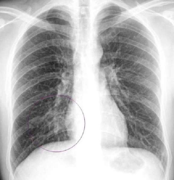 Рентген при бронхите и пневмонии
