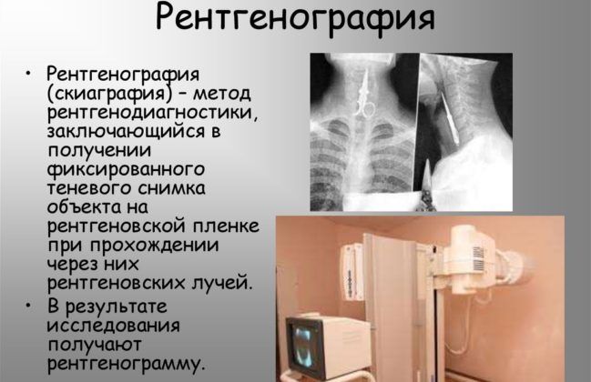 Пневмония у детей фото до и после thumbnail