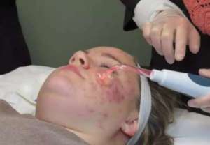 Как снять сильное воспаление кожи на лице