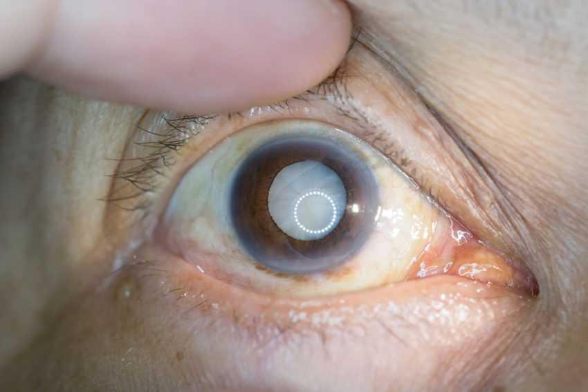 Удаление катаракты при сахарном диабете 2 типа thumbnail
