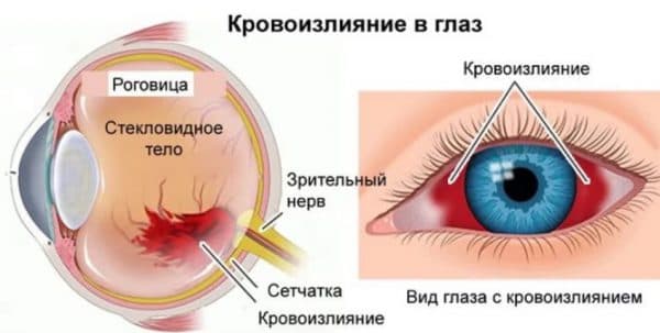 Кровоизлияние в глазу сахарный диабет thumbnail