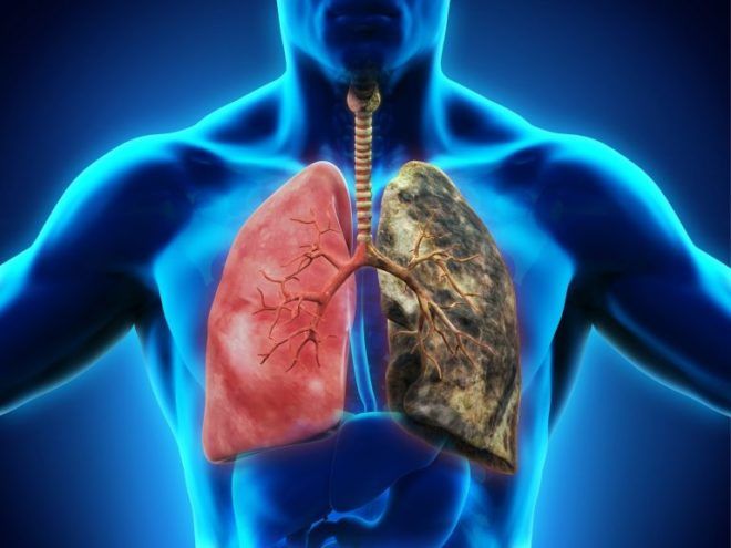 Симптомы и лечение пневмонии при туберкулезе