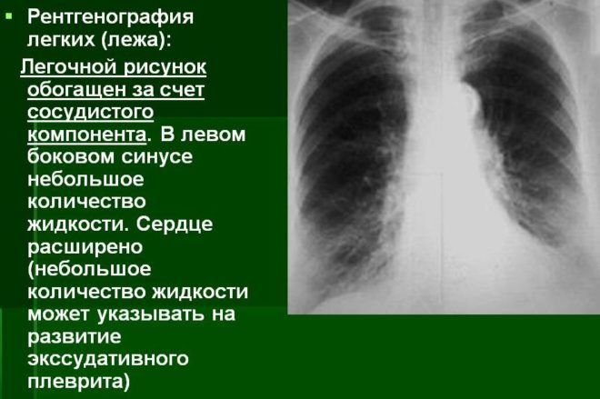 Рентген здоровых легких и при пневмонии thumbnail