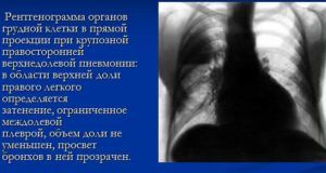 Как выглядит пневмония на снимке рентгена у ребенка thumbnail