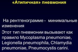 Как по рентгеновскому снимку определить пневмонию thumbnail