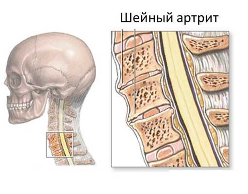 Причины и помощь при боли в затылке у основания черепа