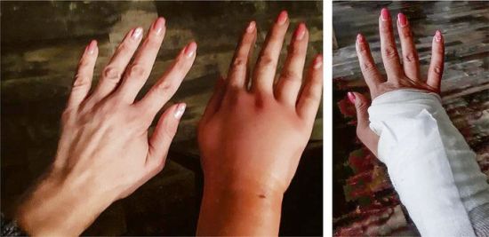 Отеки пальцев рук при травме thumbnail
