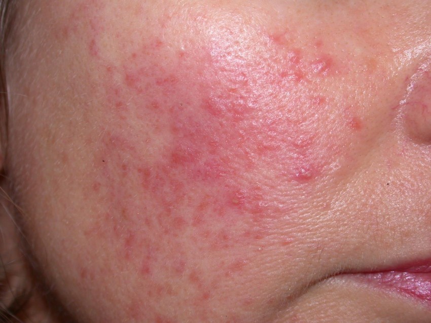 Аллергическая сыпь на лице фото
