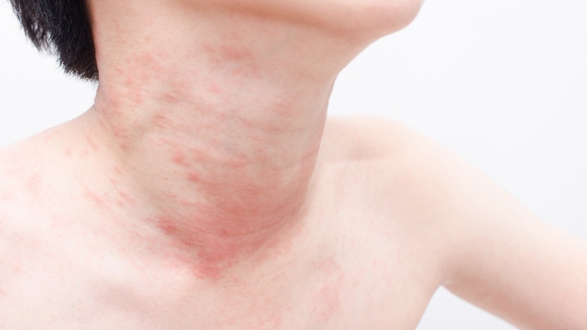 Аллергия отек фото симптомы