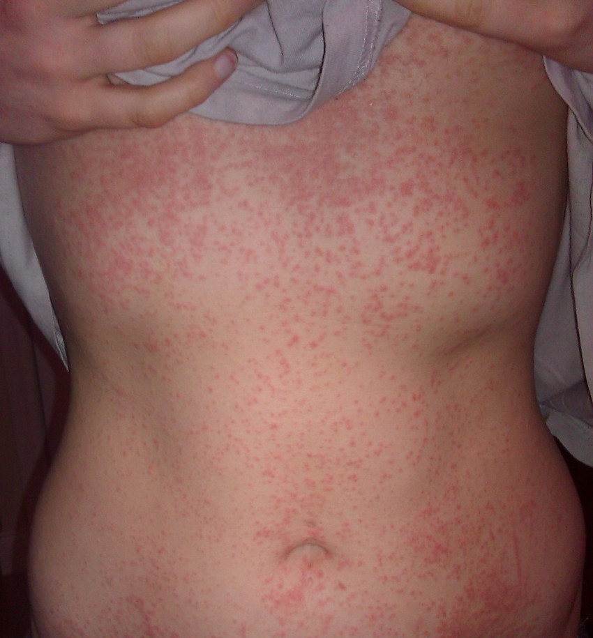 Пятна на коже аллергия или ожог