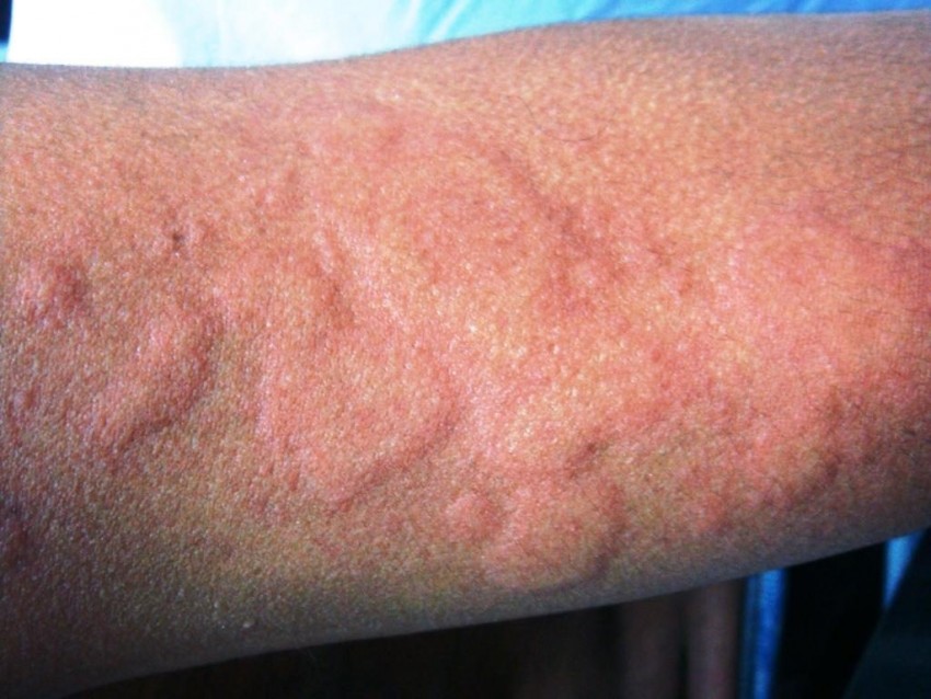 Аллергия как ожоги на теле