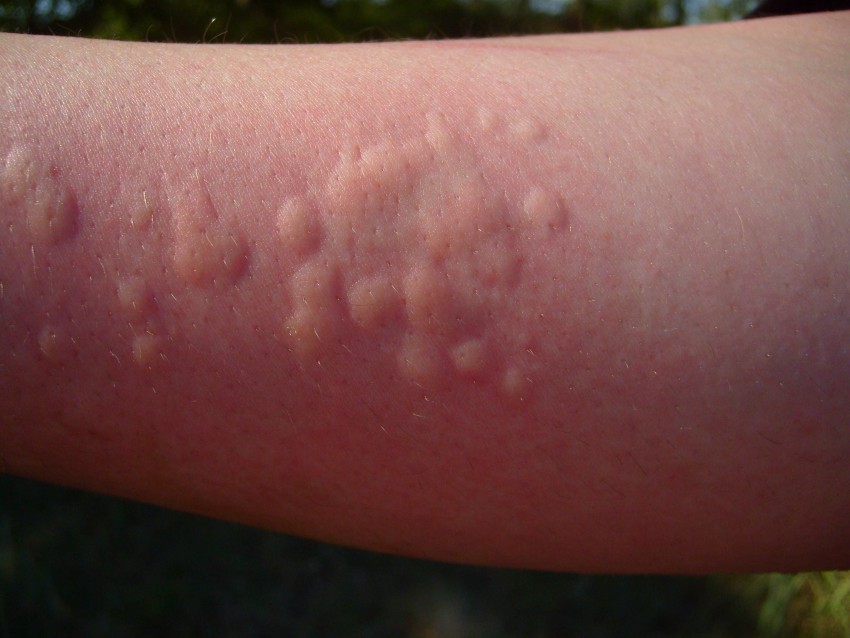 Аллергия отек ног сыпь