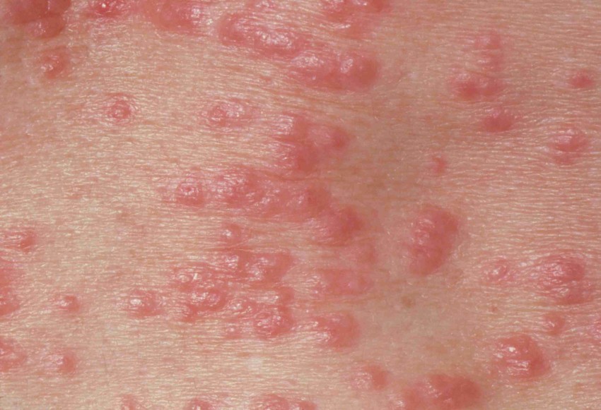 Фото аллергической сыпи у женщин