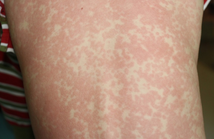 Аллергия в виде ожога на теле