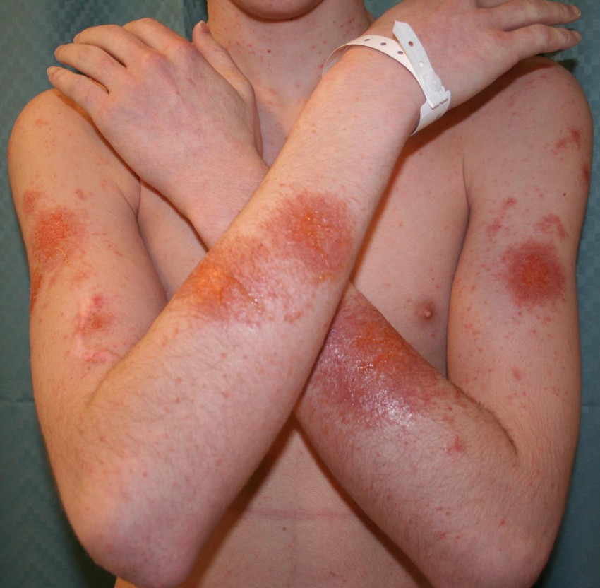 Аллергические высыпания на коже рук
