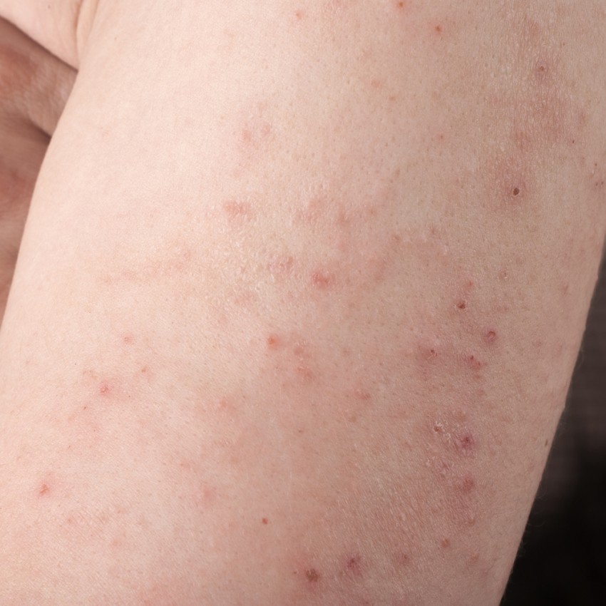 Аллергия с отеком чешется