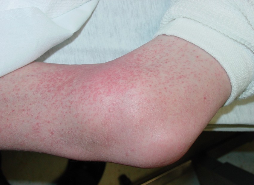 Фото сыпи при аллергии на порошок