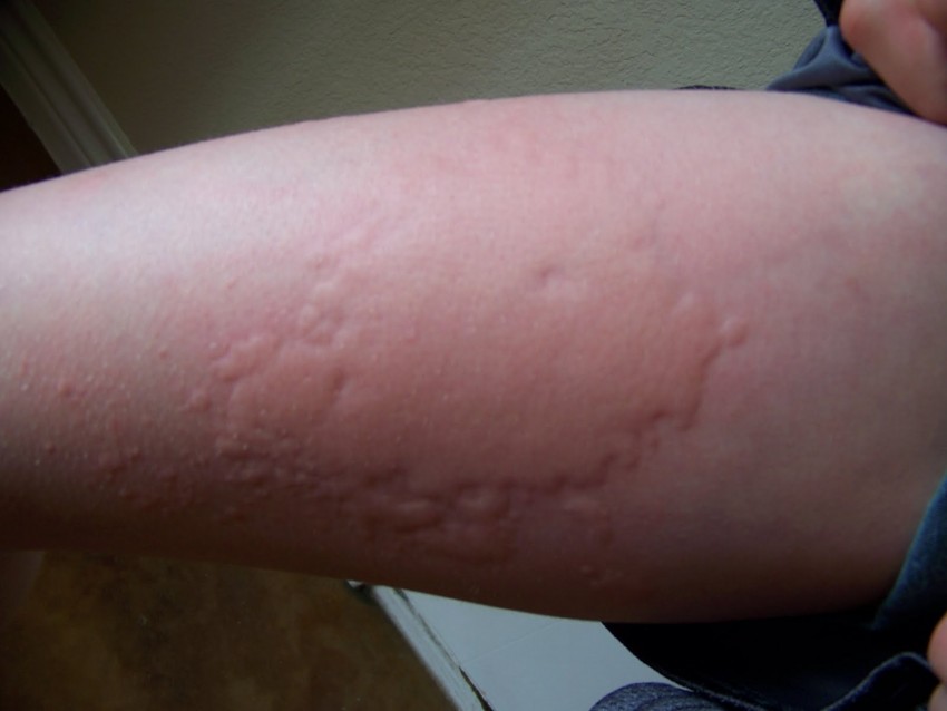 Фото аллергической сыпи у женщин
