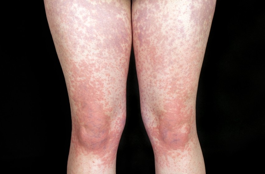 Фото аллергического дерматита у взрослых на теле