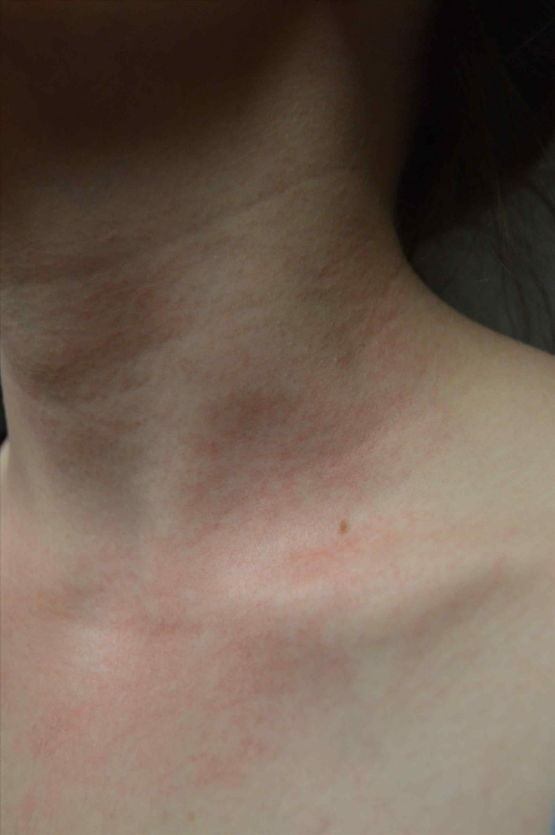 Аллергия как ожоги на теле