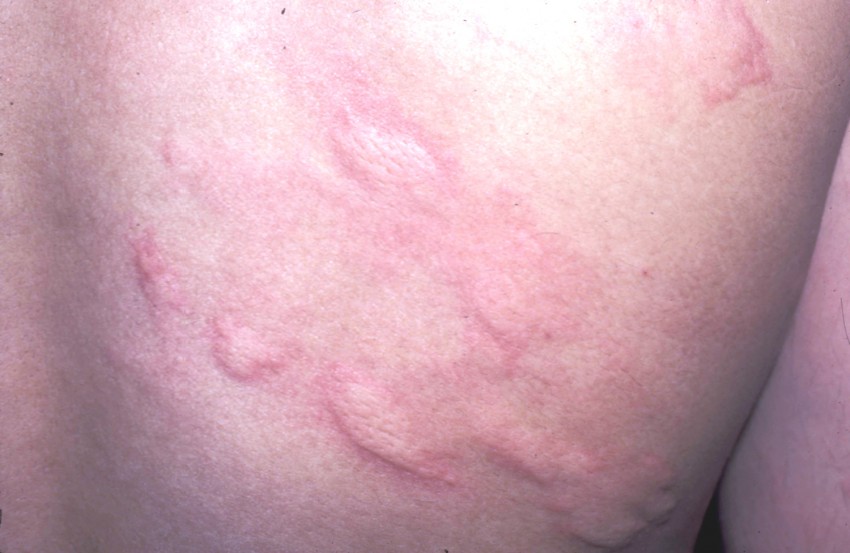 Аллергия с отеком чешется