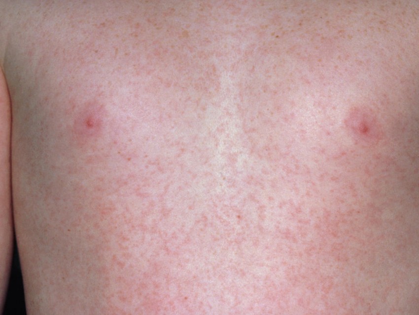 Сыпь на теле аллергия как избавиться