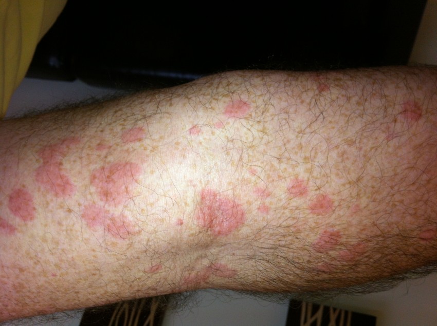 Аллергия отек ног сыпь