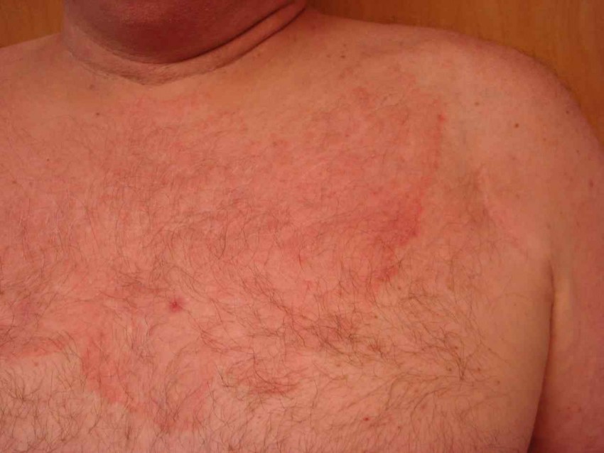 Фото аллергической сыпи у женщин thumbnail