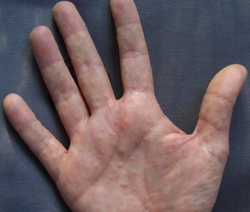 Аллергические высыпания на коже рук