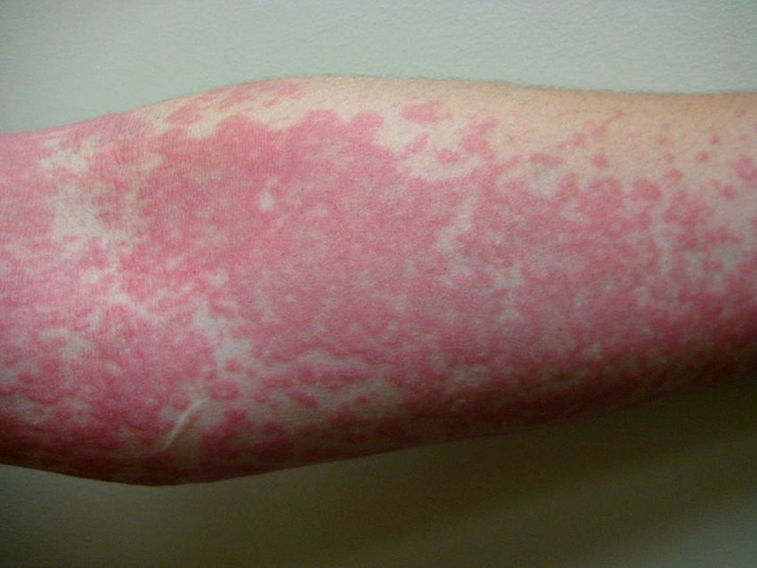 Аллергия на коже рук ног